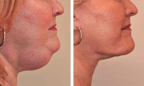 Turning back the clock through cosmetic facial surgery 2